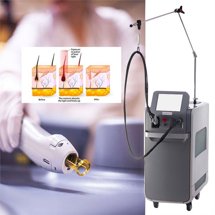 Gentlemax Pro ND YAG laser Hair Removal Machine